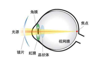 散光加近视怎么矫正，散光加远视可以矫正过来吗