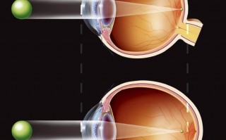 正散光是什么原理，正散光原因是什么